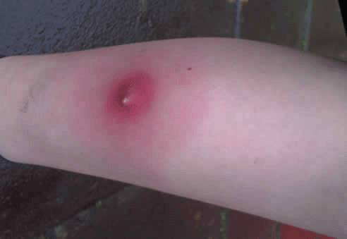 insect bite fist aid advice Insect Bites first aid